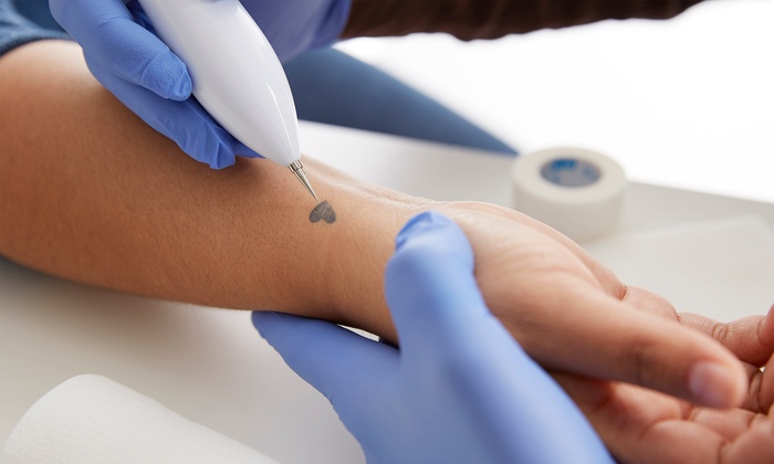 10cm x 10cm Laser Tattoo Removal: One ($89), Two ($179) or Three Sessions ($260) at Star Medispa (Up to $1,000 Value)